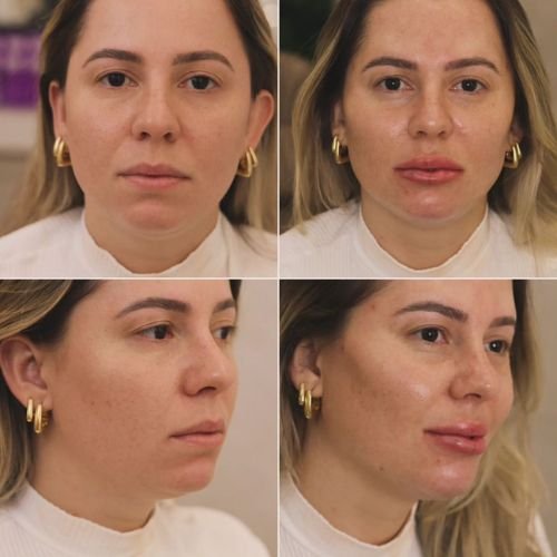 preenchimento com ácido hialuronico