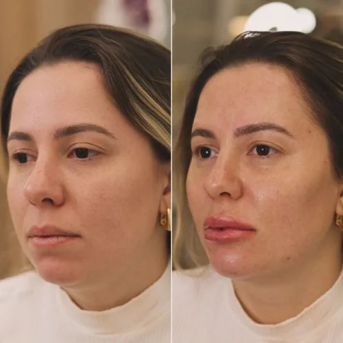 preenchimento com ácido hialuronico