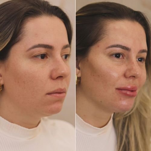 preenchimento com ácido hialuronico