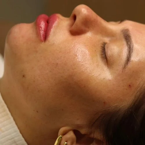 preenchimento com ácido hialuronico