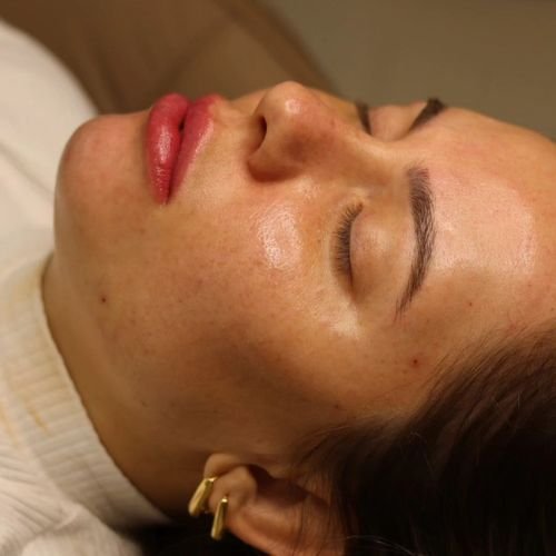 preenchimento com ácido hialuronico