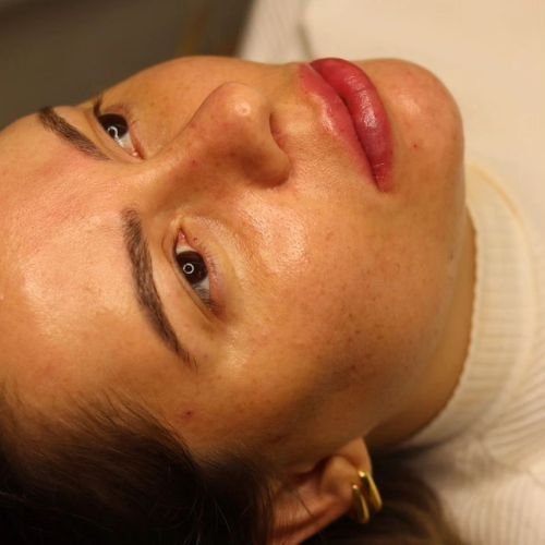 preenchimento com ácido hialuronico