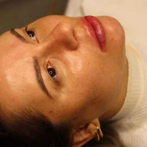 preenchimento com ácido hialuronico